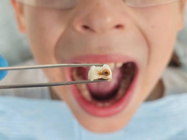 Best Emergency Dentist for Lost Fillings or Crowns in Newport News, VA