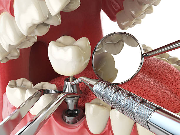 Best Emergency Dentist for Knocked-Out Tooth in Newport News, VA